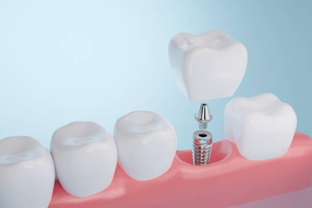 Kaip sutaupyti dantų implantų išlaidoms: 7 praktiniai būdai gauti kokybišką gydymą už prieinamą kainą